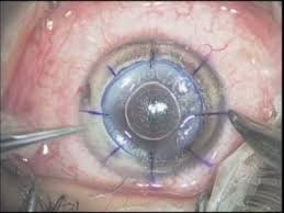 Lamellar Keratoplasty